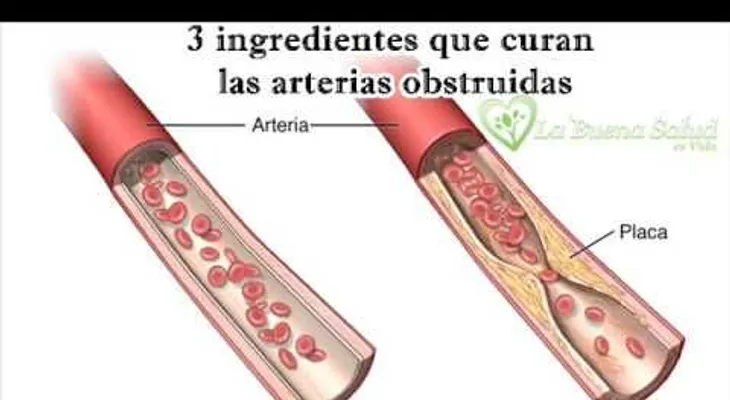 3 ingredientes que curan las arterias obstruidas (VIDEO)