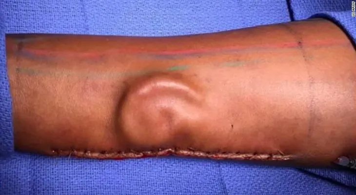 Médicos le crean una oreja en un brazo a soldado que la perdió en un accidente