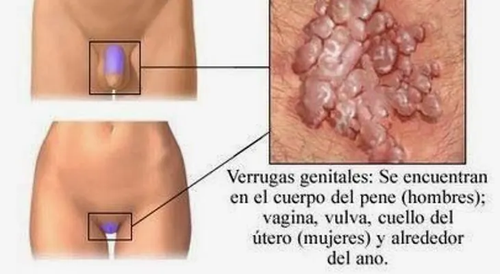 La gonorrea puede ser peligrosa para hombres y mujeres