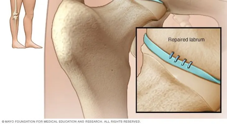Desgarro del labrum de la cadera: causas, síntomas y tratamientos