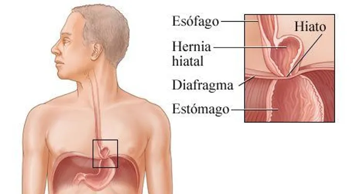 Hernia de hiato: ardor, dolor de pecho, o dificultad para tragar. Puede afectar a personas de cualquier edad 