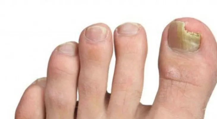 6 simples remedios para eliminar los hongos de las uñas