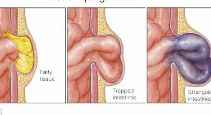 Hernias abdominales son comunes, pero no necesariamente peligrosas