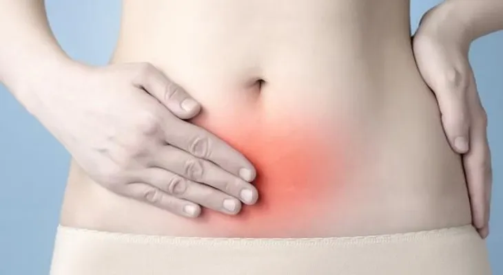  Endometriosis es una enfermedad que puede causar infertilidad en las mujeres 