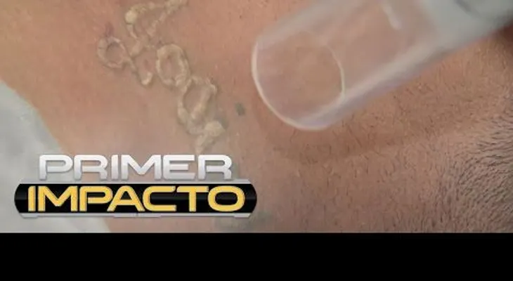 Los tatuajes ya no son para siempre; te lo puede quitar sin dolor y sin manchas