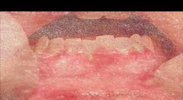 Como eliminar Herpes. Remedios Naturales