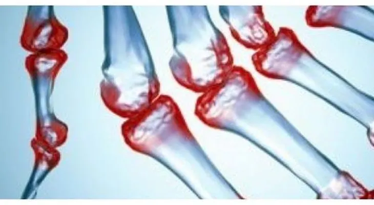Esta mezcla cura para la artritis, reumatismo y enfermedades de las articulaciones