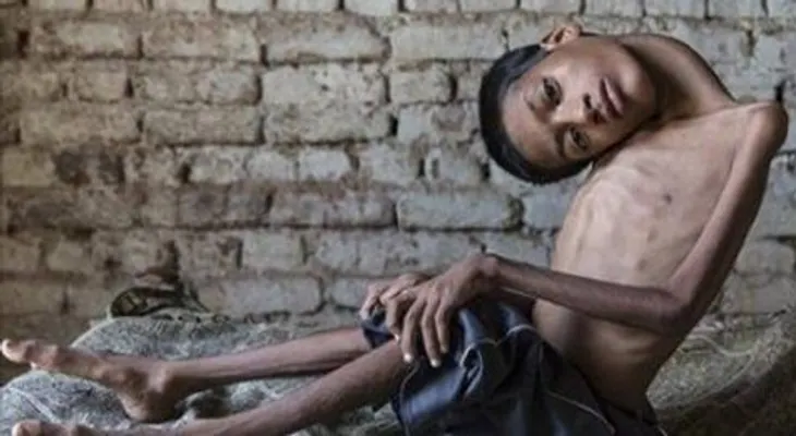 Este joven fue marginado por su horrible deformidad. Ahora luce así de increíble!