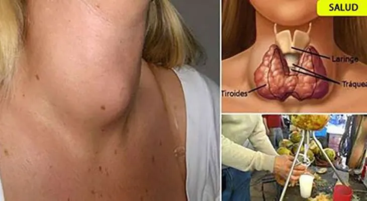 Los médicos escoden el secreto: así se cura las tiroide con tan solo este remedio