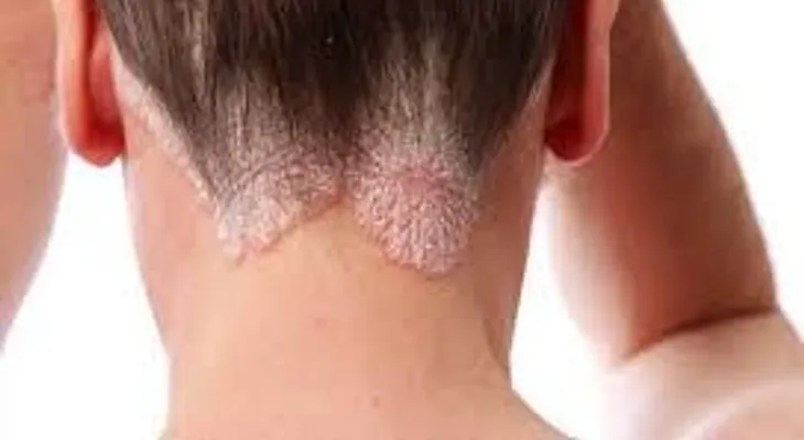 La psoriasis es más que una simple erupción 