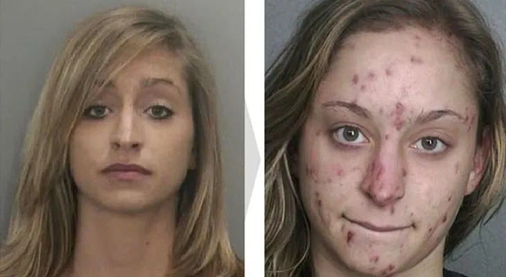 Efectos desgarradores de las drogas: ANTES Y DESPUES. Te pasaría lo mismo
