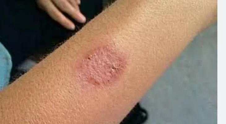 Infectólogo llama a tranquilidad población ante posible brote de ántrax a RD