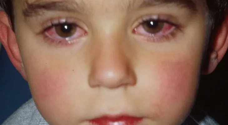 La conjuntivitis se ha convertido en viral y puede complicarse en niños