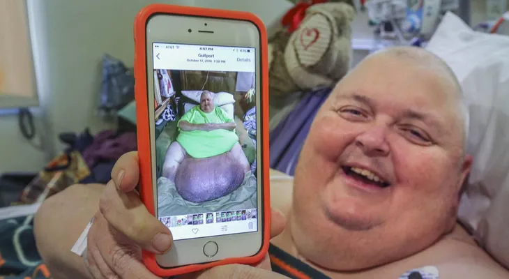 Le extirparon un tumor de casa 60 kilos que tenía hace más de una década