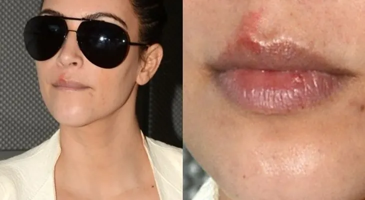 Kim Kardashian tiene herpes, y si tu tienes menos de 50 años, también puedes tenerlos 