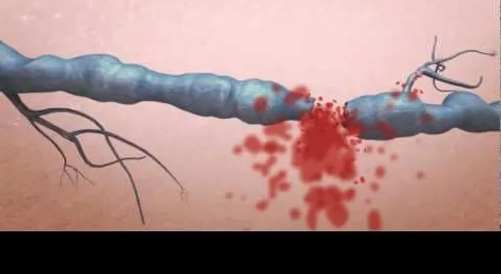 Tratamiento de varices con Laser (Video) 