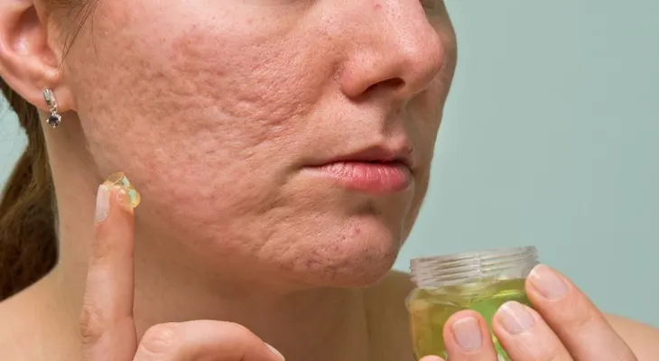 Crema para eliminar cicatrices y rejuvenecedora hecha en casa y en tan solo 10 segundos