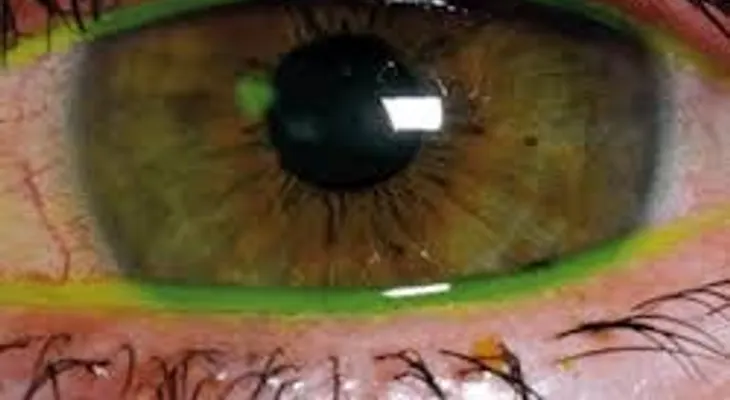 Abrasión corneal se produce cuando una córnea se lesiona y puede requerir de una operación