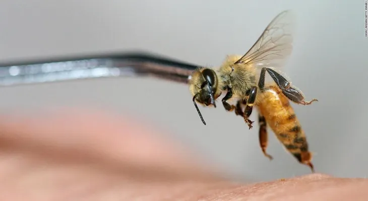 Una mujer en Madrid se sometió por dos años a una terapia contra el estrés, con abejas vivas