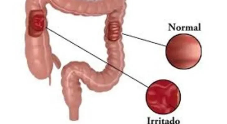 Dieta para el síndrome del intestino irritable: más común en mujeres, que hombres