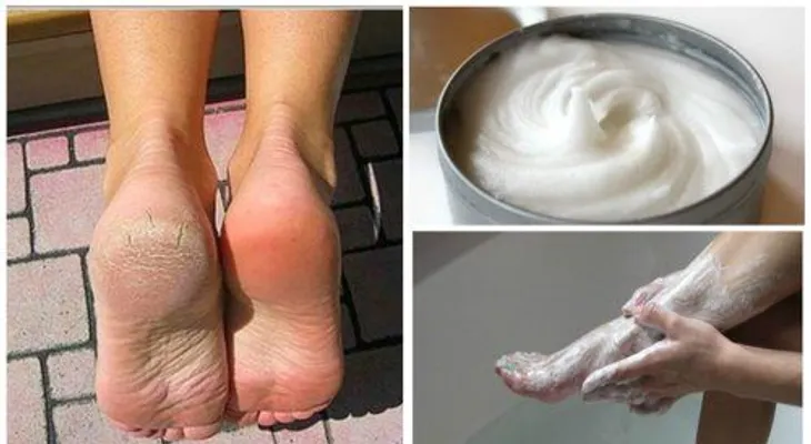 Quita los hongos y los callos de los pies con este increíble remedio. ¡Toma nota!