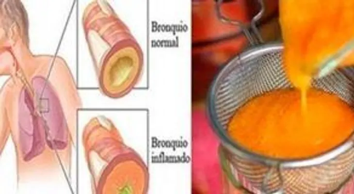 En 2 horas depúrate de la tos, gripe y flemas con este remedio