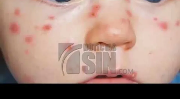 El sarampión es una enfermedad sumamente contagioso: ¿Sabe como se propaga ? 