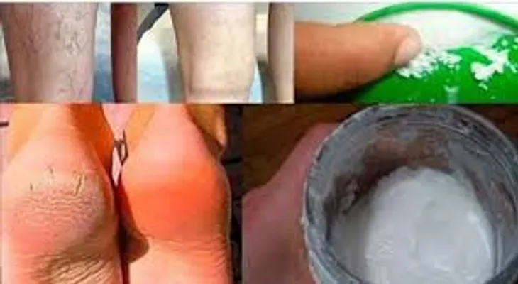 EL MILAGRO sucederá en 10 días: Remedio para curar los talones agrietados, los callos y las venas varicosas