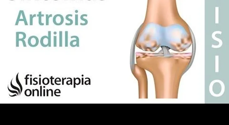  Artrosis o desgaste de rodilla - Qué es, causas, síntomas y tratamiento