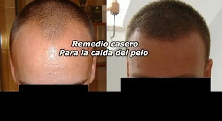Remedio para la caída del pelo (funciona de verdad!!! ) (VIDEO)