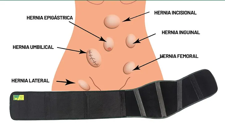 Hernia umbilical; remedios caseros 