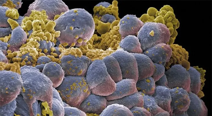 Científicos revelan cuáles son las principales causas del 90% de los casos de cáncer
