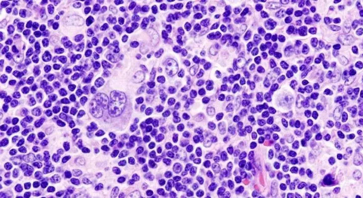 El cáncer en los glóbulos blancos afecta a 580,000 personas en el mundo