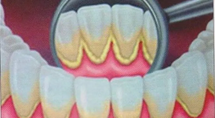 Causas del sarro en los dientes y cómo eliminarlo DEFINITIVAMENTE