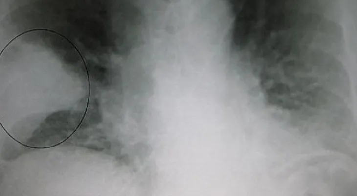 Terapia revolucionaria corrige los defectos en la fibrosis quística