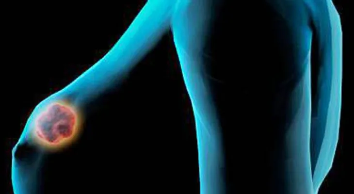 Test podría evitar quimioterapia en un 40% de pacientes con cáncer de mama