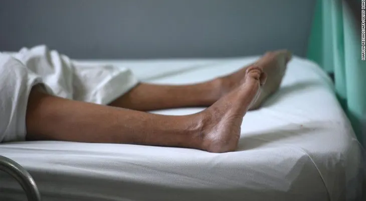 ¿Qué es el síndrome de Guillain-Barré y qué tiene que ver con el zika?