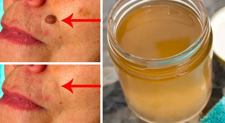 Quítate las verrugas, espinillas y las manchas por edad con este simple tratamiento
