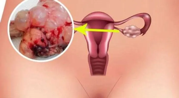 6 Síntomas del Síndrome de Ovarios Poliquísticos