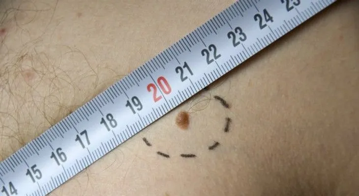10 cosas que no sabías sobre el melanoma.