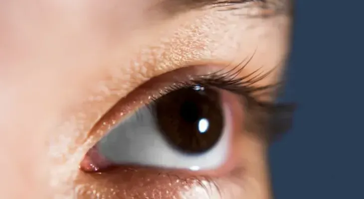 Cuidado con el glaucoma si tienes miopía