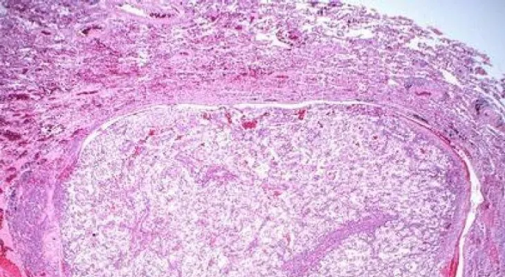 La metástasis sigue siendo el agujero negro en el tratamiento del cáncer