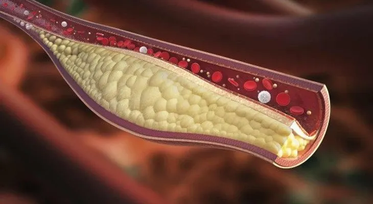 Los mejores ejercicios para reducir el colesterol