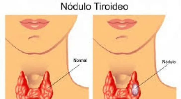   Nódulos tiroideos dificultan el control glucémico   