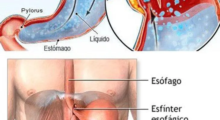 Pautas nutricionales que debes seguir para el reflujo gastroesofágico