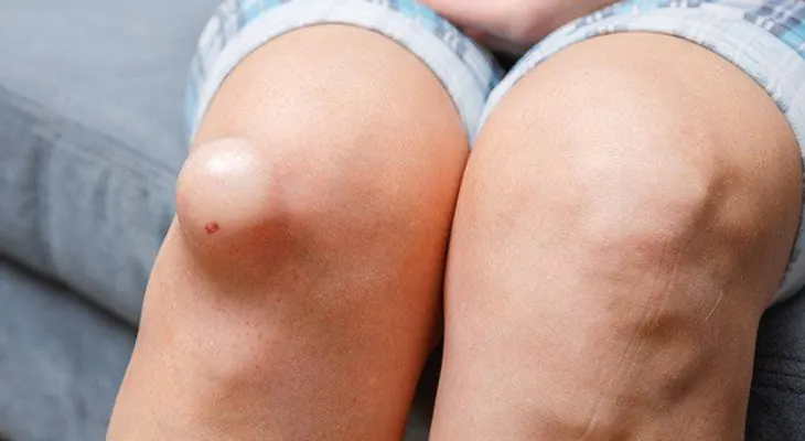 Líquido en las rodillas, alivia su dolor y desinflama con estos remedios