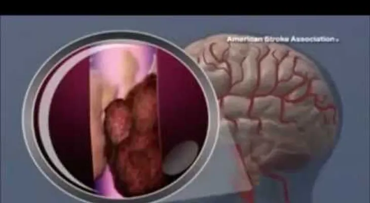 Accidente cerebrovascular (VIDEO)