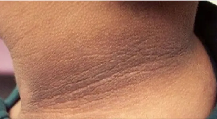 2 Eficaces remedios caseros para tratar el cuello oscuro