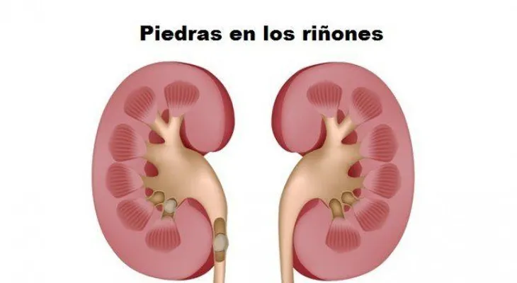 Jarabe potente para eliminar las piedras en los riñones