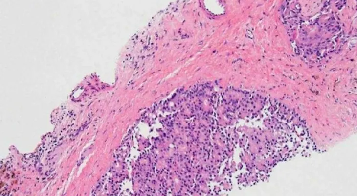 Esto influye sobre tasas de biopsia y complicaciones relacionadas